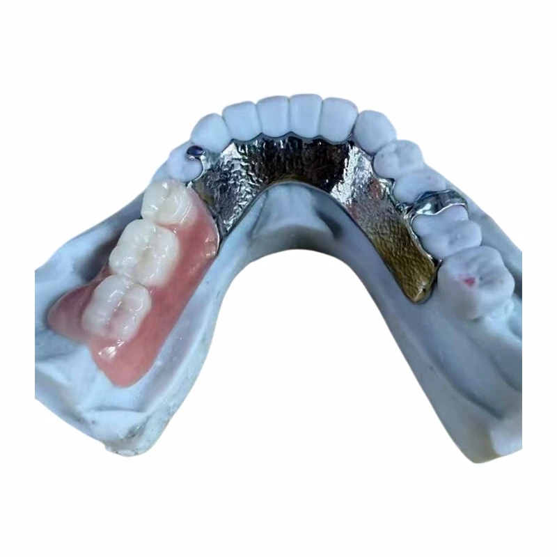 Vitallium metalramme og delvis akrylprotese